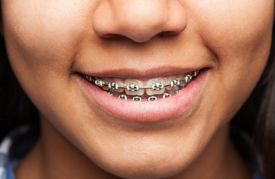 Orthodontics types: 5 dentistry treatments to have the best smile